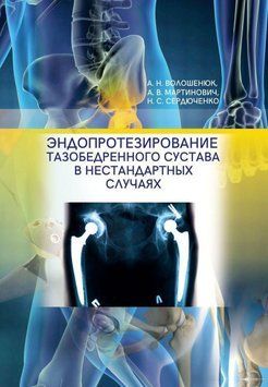 Эндопротезирование тазобедренного сустава в нестандартных случаях 51248864 фото